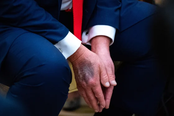 Aug. 25. President Donald Trump sporting a dark bruise on his right hand.